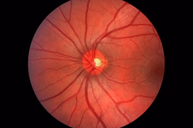 Glaucoma exams in Saratoga Springs, NY